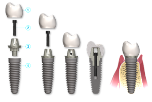 impianti-dentali-protesi-avvitata