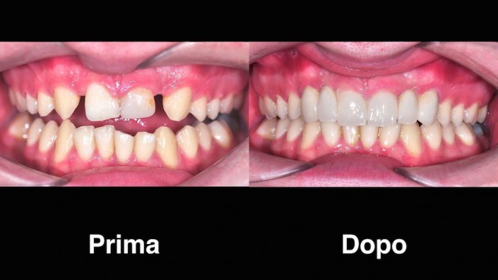 Quanto Costa Mettere Un Dente In Croazia